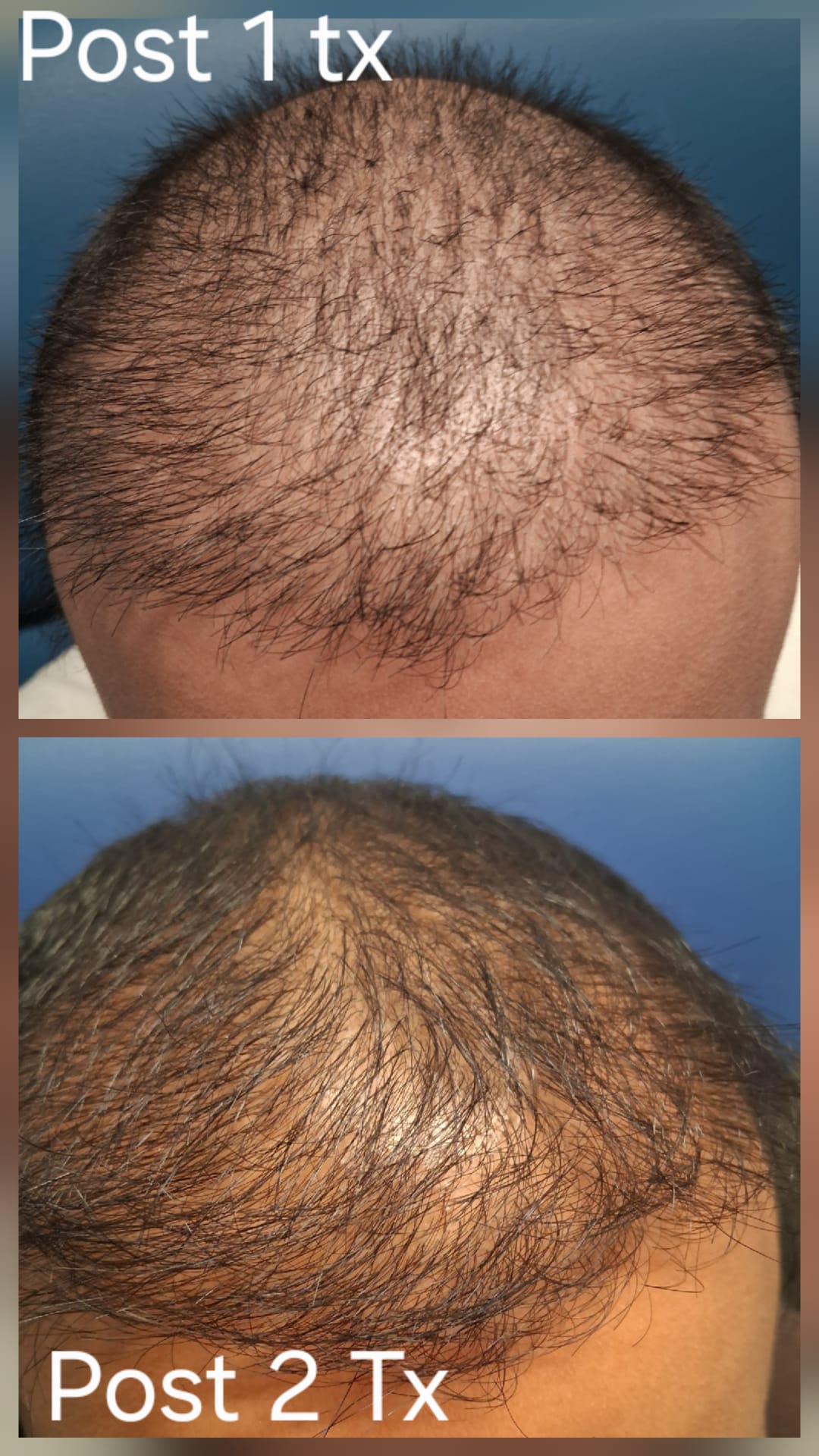 Hair restoration result